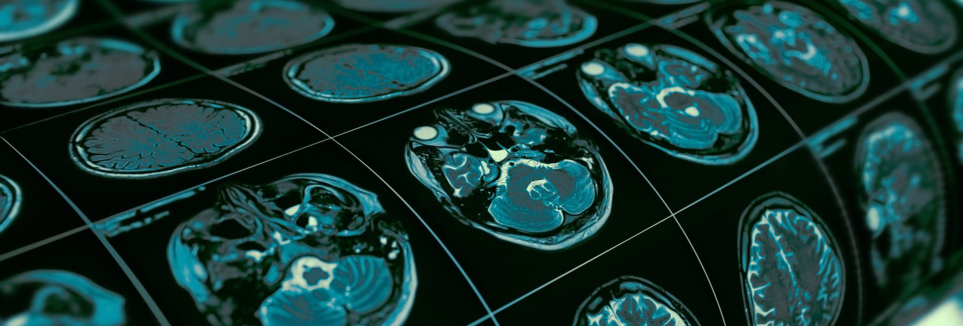 Identify Stroke Symptoms With This FAST Quiz