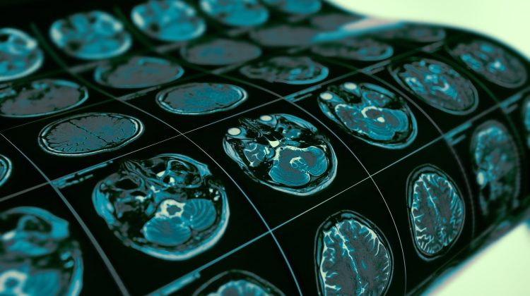 An image of a series of brain scans sitting on a table
