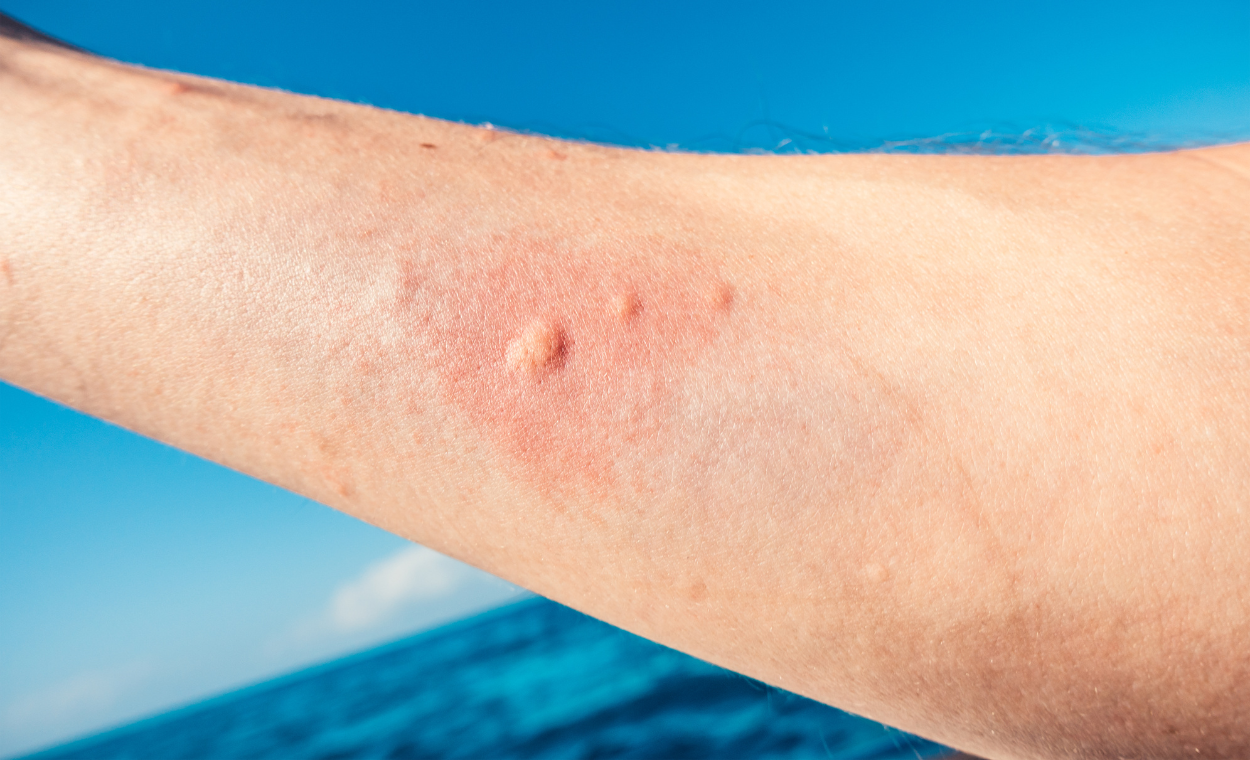 Image of a jellyfish sting.