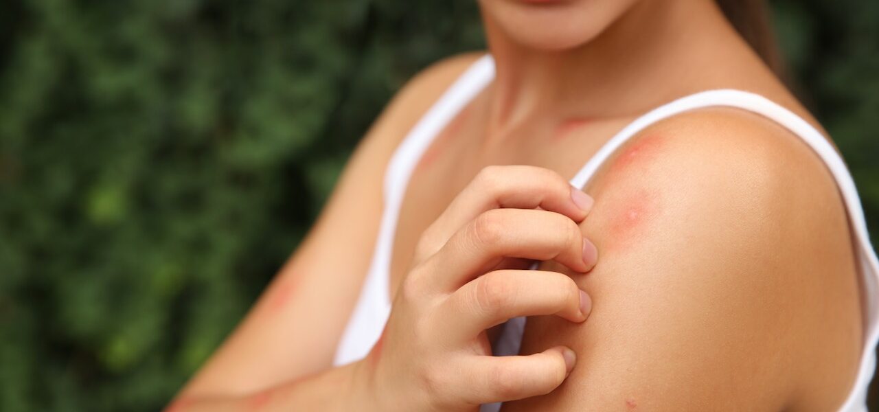 Insect Bite Prevention Tips and How to Make Bug Bites Stop Itching