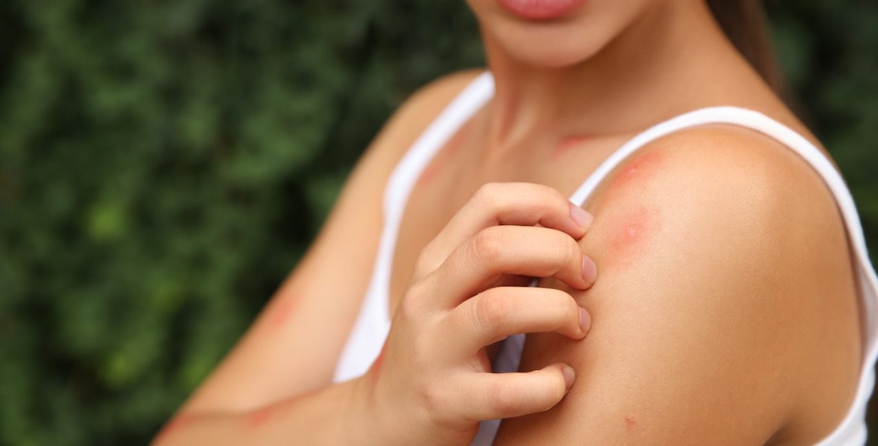 Insect Bite Prevention Tips and How to Make Bug Bites Stop Itching