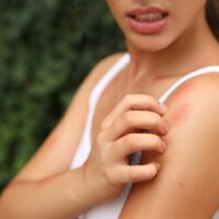 Woman scratching shoulder with insect bite outdoors, closeup