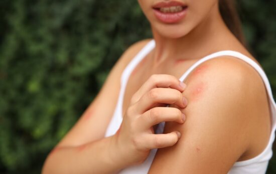 Woman scratching shoulder with insect bite outdoors, closeup