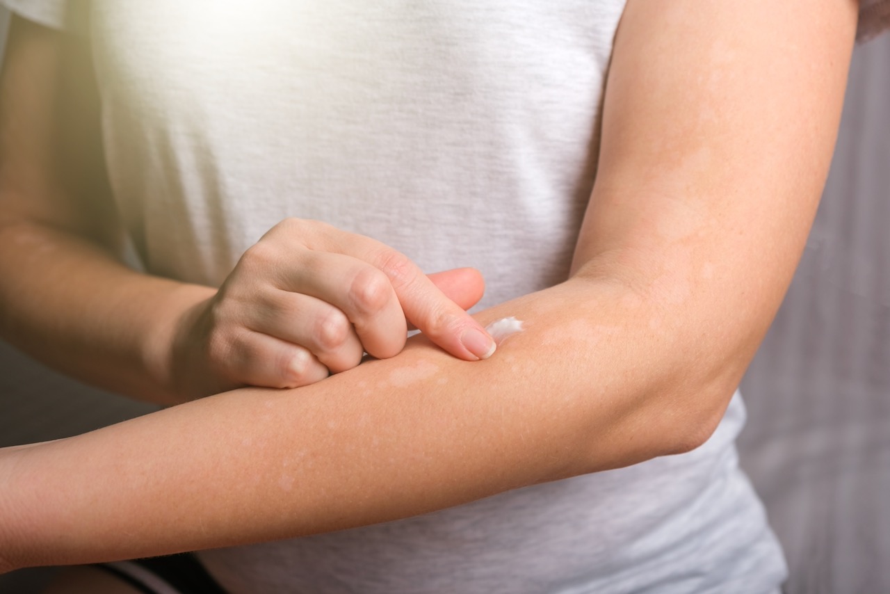 Young woman smears her hands with anti-itch dermatitis cream. Allergic dermatitis. Skin disease vitiligo. Neurodermatitis disease, eczema or allergy rash. Healthcare and Medical